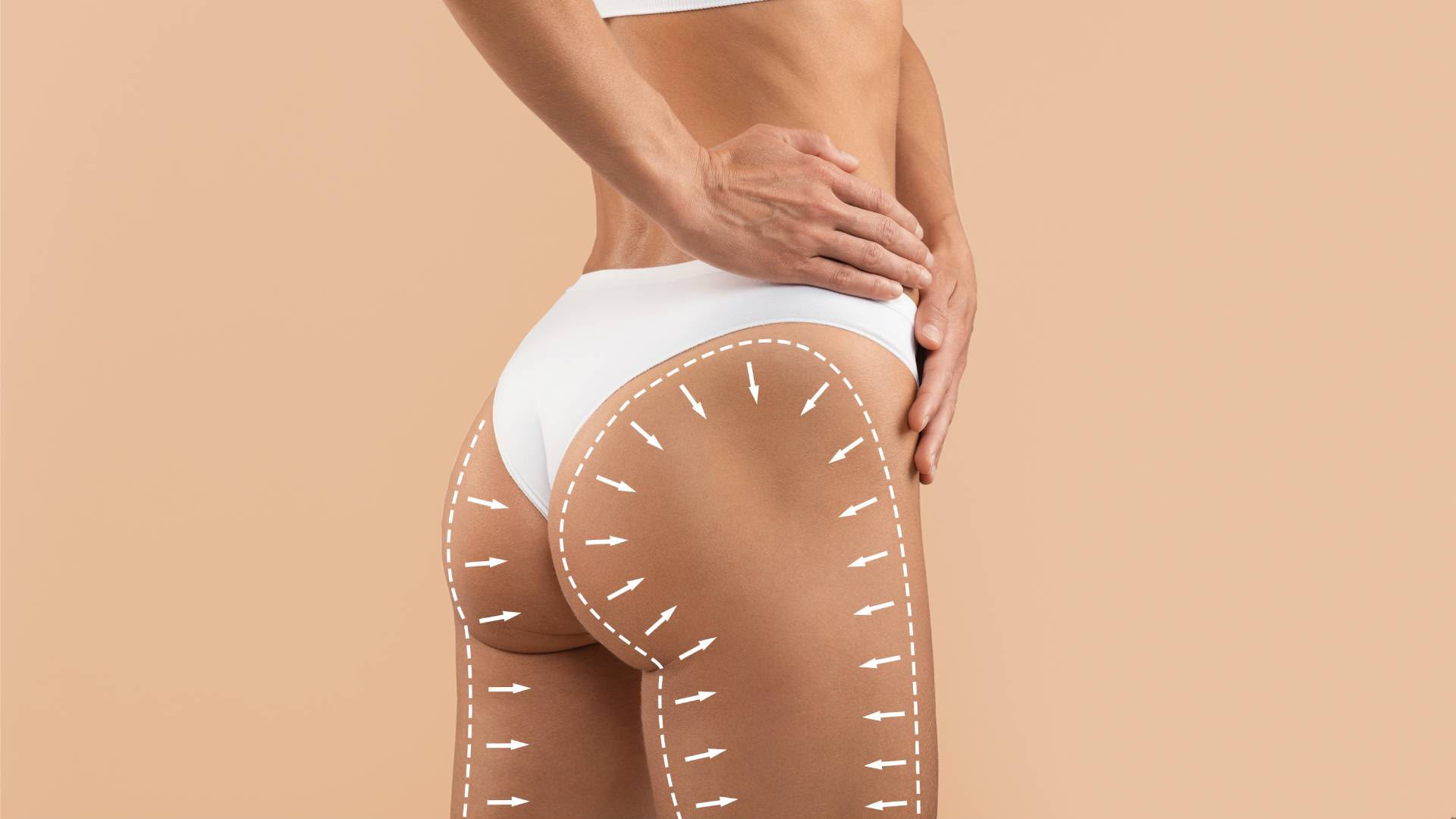 EsteCenter İstanbul’da Brazilian Butt Lift (BBL)