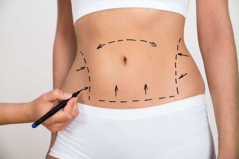 EsteCenter İstanbul’da karın germe (abdominoplasti)