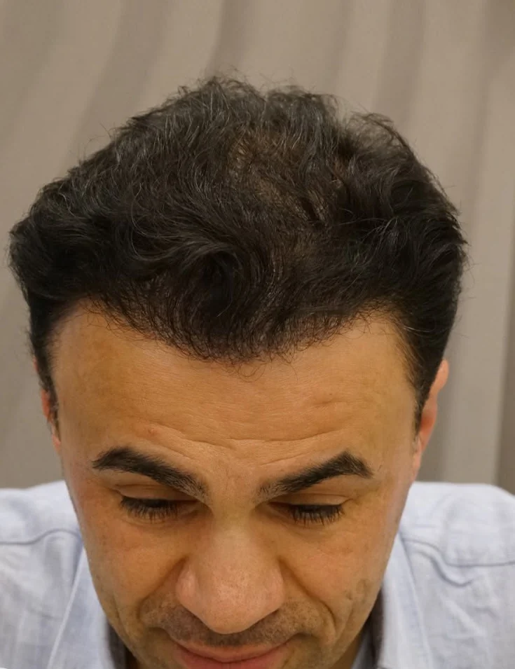 Saç ekimi sonrası sonuç