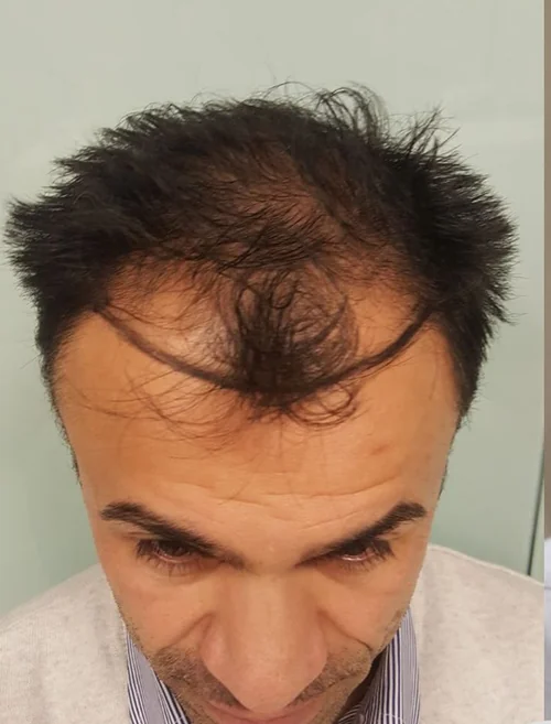 Saç ekimi öncesi
