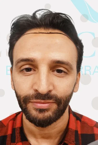 Saç ekimi öncesi